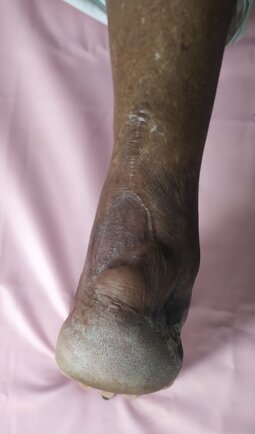 Diabetic foot ulcer treated with a flap